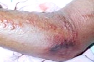  La Mauritanie rapporte un cas biologiquement confirmé de fièvre hémorragique de Crimée-Congo