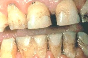 Mauritanie /Santé : 79% de caries dentaire dans le milieu scolaire